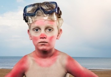 Eritema Solare: Cause, durata e rimedi per una pelle protetta e sana